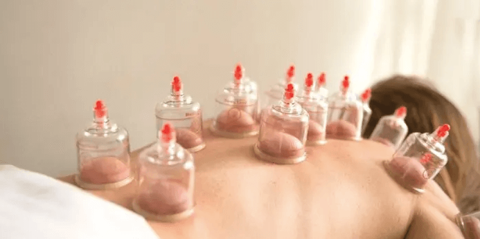 Cupping Terapéutico